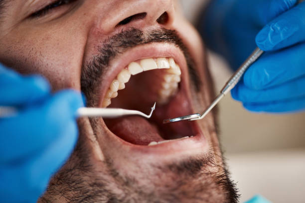 Best Emergency Wisdom Teeth Removal in Stevensville, MI